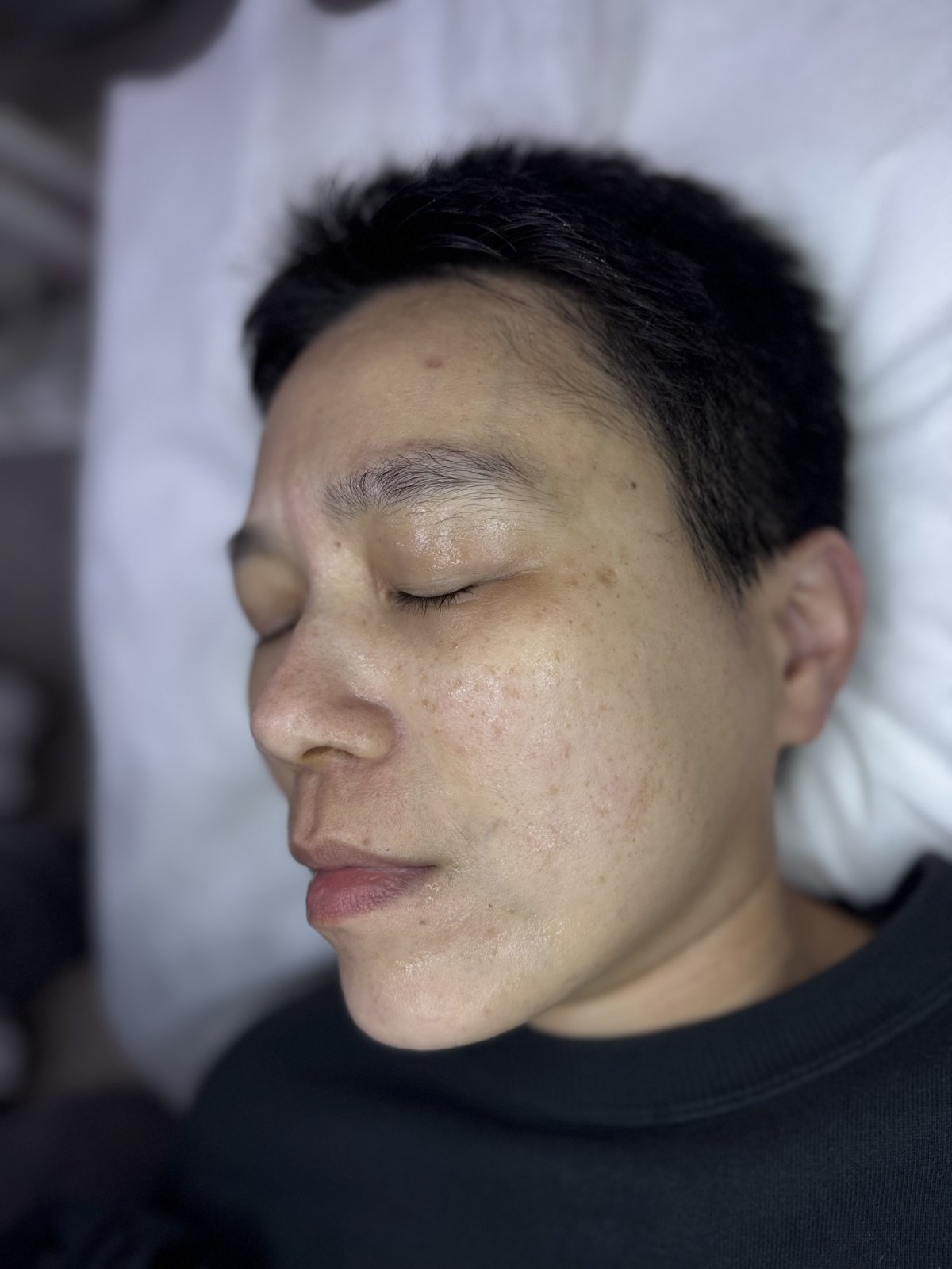 佩穎 療程前